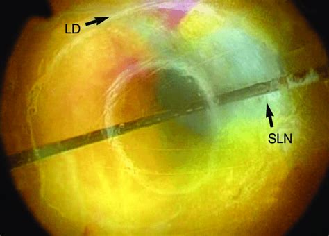 Endoscopic View Of Sentinel Lymph Node And Draining Lymph Duct Through