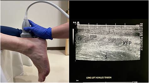 Achilles Tendon Tear Ultrasound