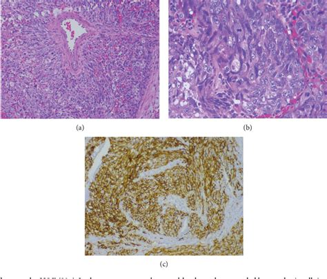 Figure 3 From Primary Cardiac Epithelioid Angiosarcoma In A Latin