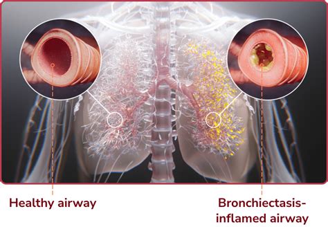 Bronchiectasis Causes Symptoms And Exacerbations Rethink Bronchiectasis