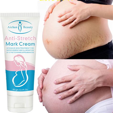 Jual Penghilang Strech Mark Strechmark Cream Ml Mama Choice Stretch