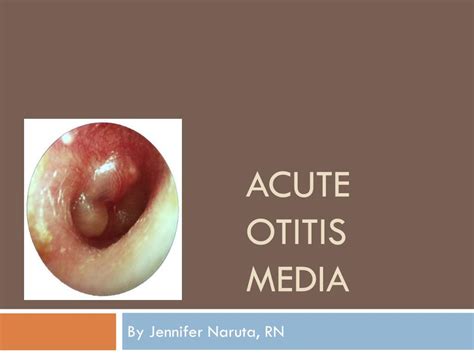 Ppt Acute Otitis Media Powerpoint Presentation Free Download Id