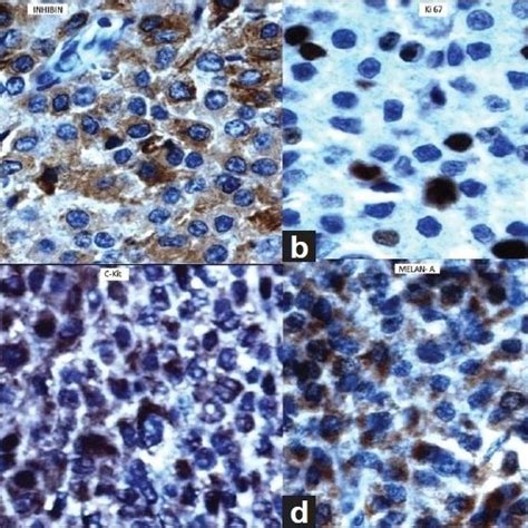 Adrenocortical Carcinoma Immunehistochemistry Tumor Cells Showing Download Scientific