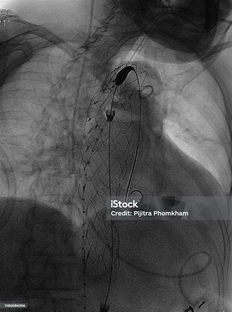 Endovascular Aneurysm Repair Procedure Stock Photo - Download Image Now ...