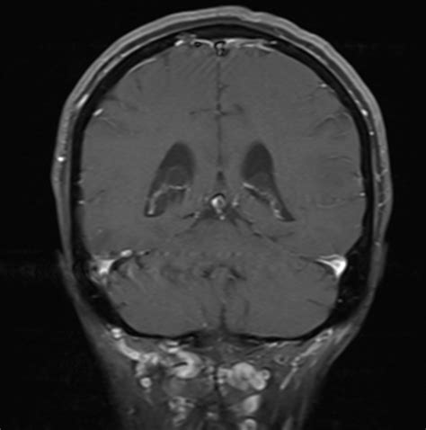 Amyloid Related Imaging Abnormalities Aria Image Radiopaedia Org