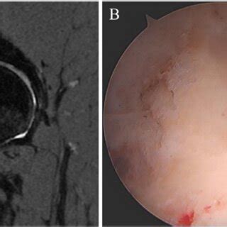 Labral Tear And Full Thickness Acetabular Chondral Wear Right Hip