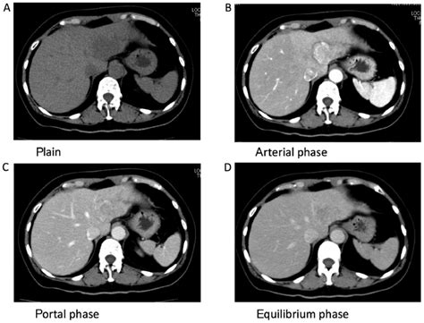 Preoperative Abdominal Ct Of The Liver Tumor A Ct Demonstrated A Download Scientific Diagram