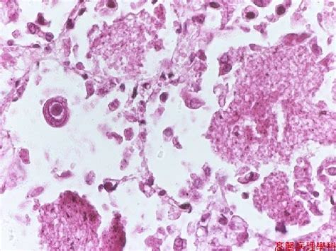 Kmu Pathology Lab《slide 44》pneumocystis Carinii Pneumonia And Cytomegalovirus Cmv Pneumonitis Lung