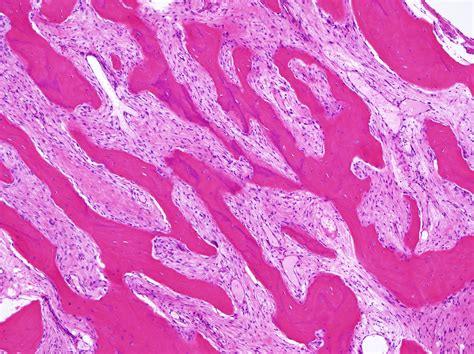 Parosteal Osteosarcoma