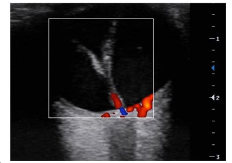 Ocular Ultrasound A V Shaped Membrane Attached To The Optic Nerve Head Download Scientific