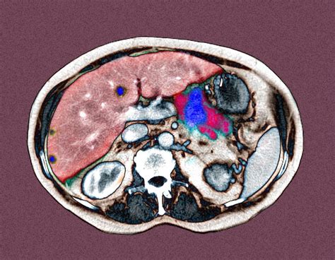 Metastatic Pancreatic Cancer Ct Scan Photograph By Du Cane Medical