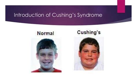 Cushings Syndrome 4