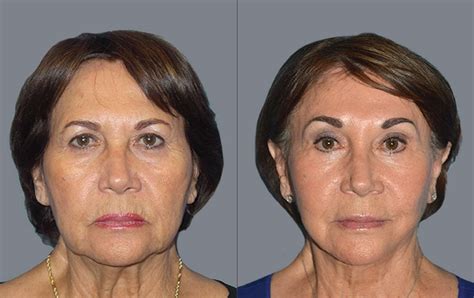 Plastic Surgery Before And After Face Transform Your Look With These Dramatic Results