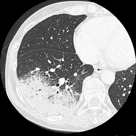 Summary Of Cases Of Presumed Daptomycin Induced Eosinophilic