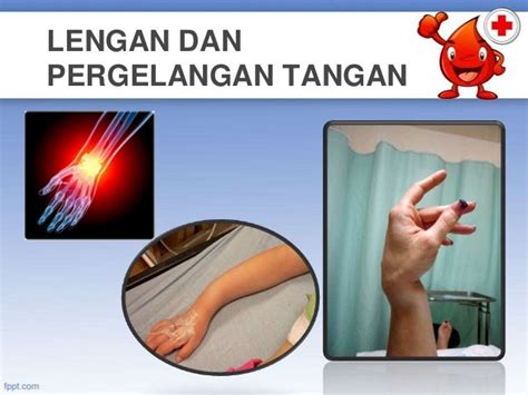 anduh tangan patah tertutup historyploaty