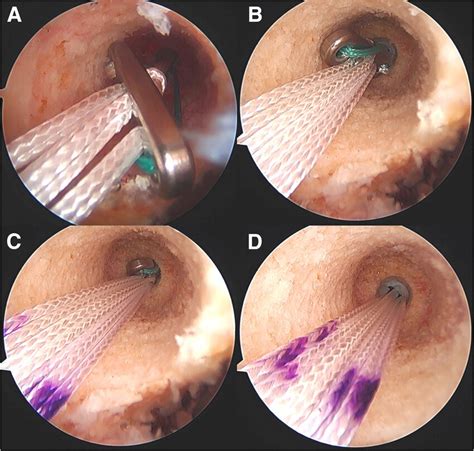 Intraoperative Arthroscopic Photos During An Anterior Cruciate Ligament