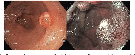 Figure 1 From Evaluation And Management Of Gastric Epithelial Polyps