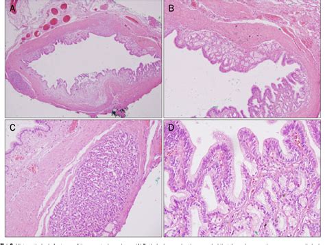 Figure 2 From Gastric Duplication Cyst Removed By Endoscopic Submucosal