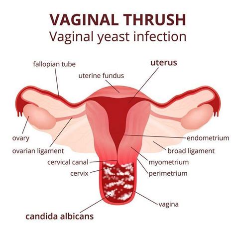 Vaginal Bacterial Infection Sores