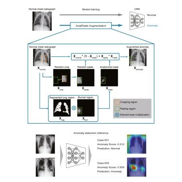 Anatomy Aware Self Supervised Learning For Anomaly Detection In Chest