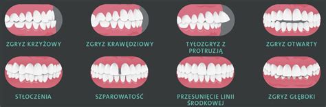 Wady Zgryzu Dentus Szczecin