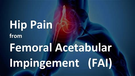 Hip Pain From Femoral Acetabular Impingement FAI What Is It And How