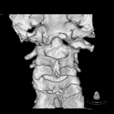 Klippel Feil Syndrome X Ray