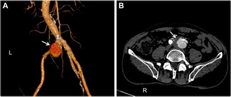 Frontiers Case Report A Pseudoaneurysm Involving The Left Common