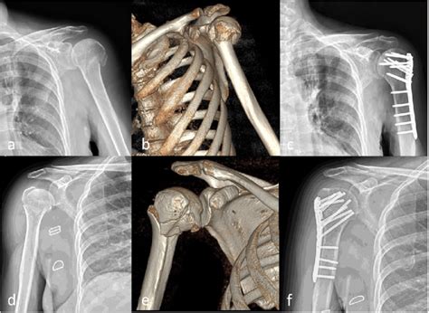 A Radiograph Of A Year Old Woman With Neer Classification Of