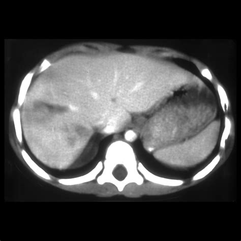 adrenal hemorrhage | pacs