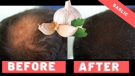 Garlic For Hair Growth How To Use It And Does It Work Youtube