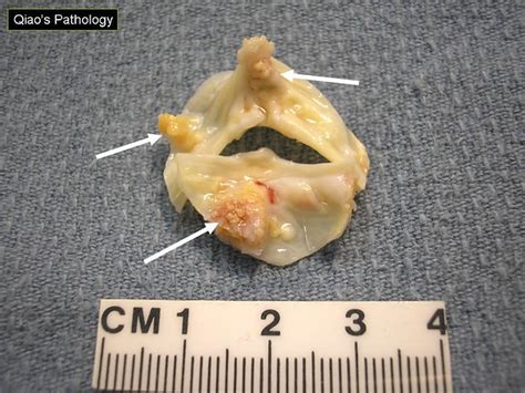 Stenosis: Bicuspid Aortic Valve Stenosis