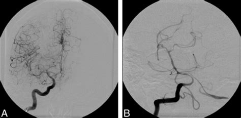 Cerebral Vasospasm Openanesthesia