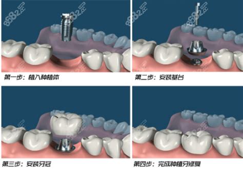 口腔医院种一颗牙需多少钱2023年种牙价格大概是2499 19780元牙齿对比照片 8682整形网