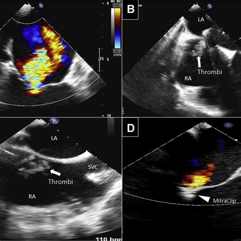 Thrombus Formation At The Transseptal Puncture Site During MitraClip