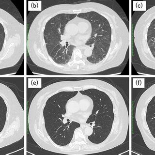 High Resolution Computed Tomography Images Of The Chest At The Time Of