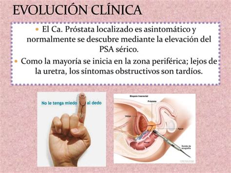 Hiperplasia Nodular Y Carcinoma De Pr Stata Ppt