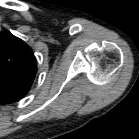 Reverse Hill Sachs And Reverse Bankart Lesions Radiology Case