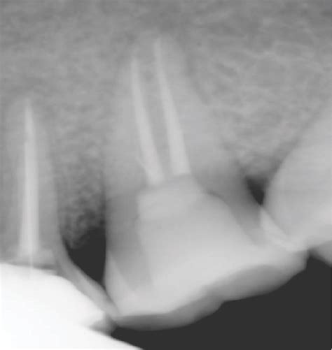 Cemented endocrown. | Download Scientific Diagram