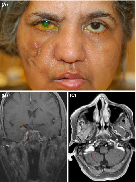 Misdiagnosis Of Bells Palsy Case Series And Literature Review Bacorn 2020 Clinical Case