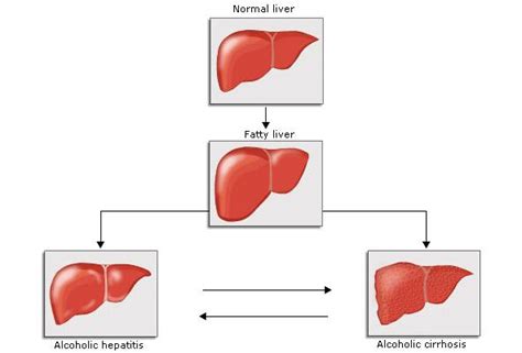 Rcem Learning Alcoholic Liver Disease Reference Material