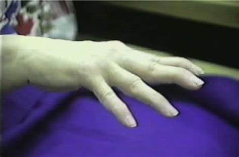 Handrehab Swan Neck Deformity Course And Boutonniere Deformity Course