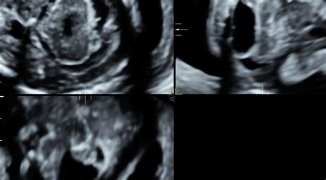 Advanced Fetal Neurosonography When Do I Need To Refer For Fetal MRI