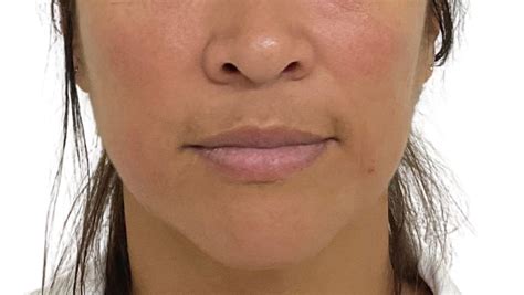 Premium Nasolabial Fold Filler In Sydney Cbd Nova Cosmetic Clinic