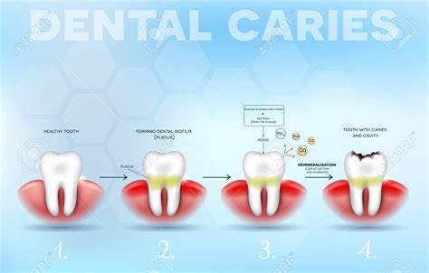 Symptoms and Treatments of Dental Caries - Check Biotech First