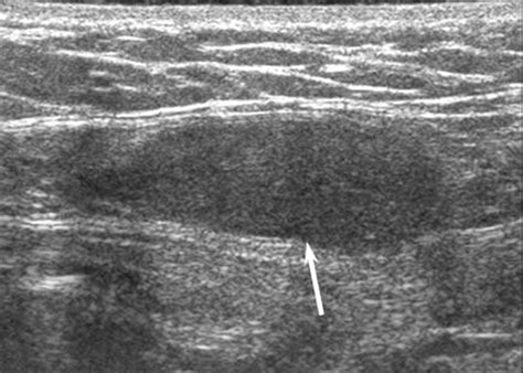 Sonographic Findings Of Groin Masses Yang 2007 Journal Of Ultrasound In Medicine Wiley