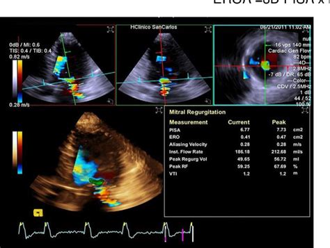 Figure From Assessment Of Functional Mitral Regurgitation Severity By