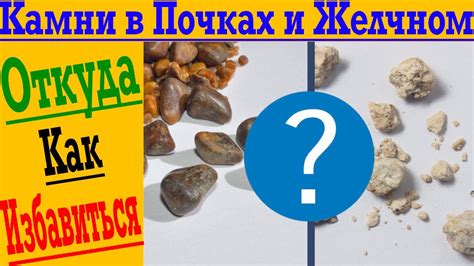 Откуда берутся камни в почках и желчном? Как избавиться от камней ...