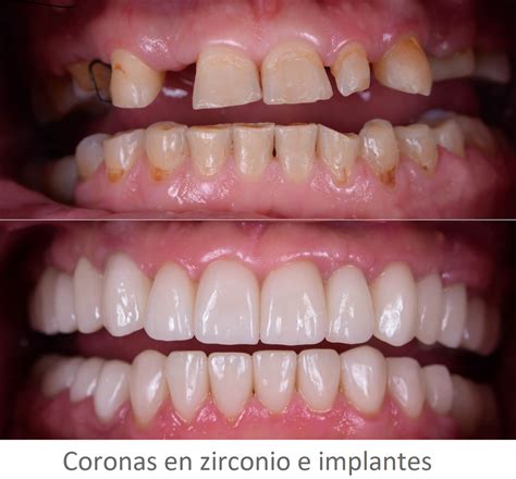 Coronas Dentales Zirconio Coronas Porcelana Medellin