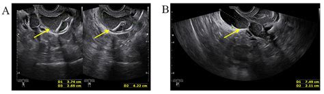 Threedimensional Transvaginal Ultrasound A Transvaginal Ultrasound